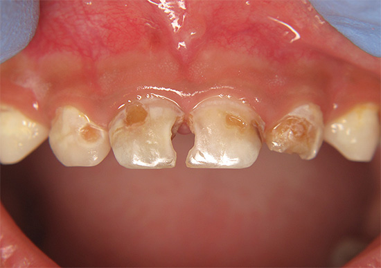 Wenn Sie einen Zahnarztbesuch für längere Zeit verschieben, kann beispielsweise ein Kind vorzeitig ohne Zähne bleiben.