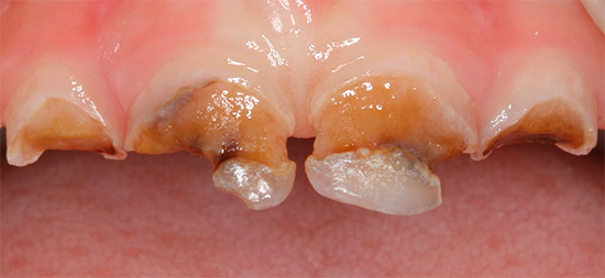 In the acute form, caries can destroy teeth in a very short period of time ...