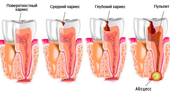 This picture shows the sequence of stages through which a tooth passes when it is damaged by caries, if it is not treated.