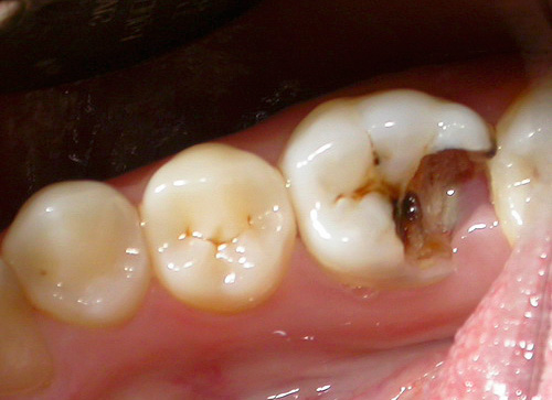 Tai prieš dantį atrodo kaip dantis su gilia kariesine ertme