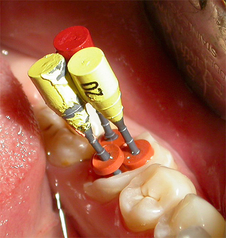 When depulping such a tooth, it is necessary to clean and fill all the root canals at once.