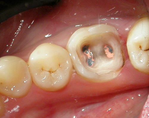 Soarta dintelui în multe privințe depinde de calitatea tratamentului canalului, deci această etapă este foarte responsabilă.