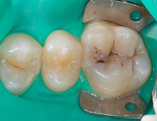 The photo shows the preparation of a tooth with fissure caries for treatment: the affected tissue will be excised, after which they will be replaced with filling material.