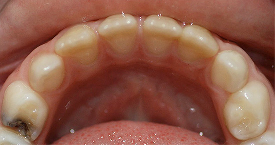 Il processo carioso può interessare un singolo dente, mentre tutti gli altri rimangono sani.