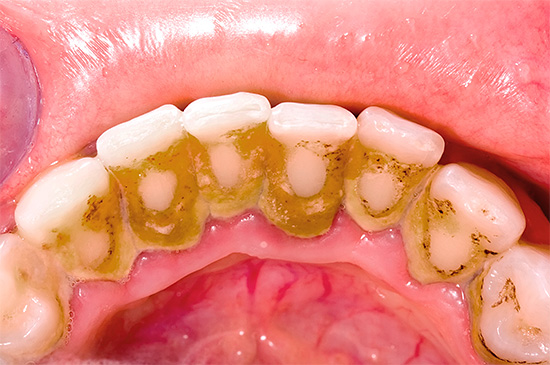 I närvaro av tandplack är det nödvändigt att konsultera en tandläkare för att ta bort dem, eftersom karies under dem mycket väl kan börja utvecklas i hemlighet.