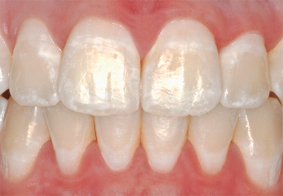 White spots on the teeth are areas of demineralized enamel