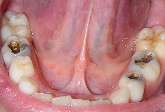 Fotografie ukazuje několik zubů zasažených hlubokým kazem a tento stav není daleko od pulpitidy, kdy bude muset být nerv během léčby odstraněn.