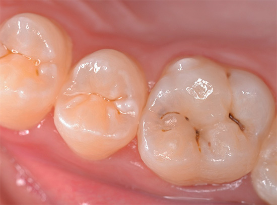 Very often tooth fissures are affected by caries - natural depressions on its chewing surface.