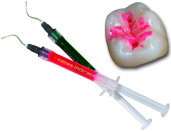 Eri värisiä kariesmarkereita käytetään nykyään laajasti hammaslääketieteessä emalin ja dentiinin karioisten alueiden visuaaliseen havaitsemiseen.