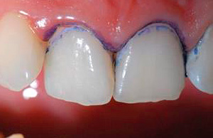 Es ist wichtig zu berücksichtigen, dass der Indikator nicht nur die von Karies betroffenen Gewebe, sondern auch Plaque und Zahnstein färben kann.