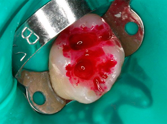 Uskutočnila sa príprava, po ktorej nasledovalo spečenie vyčistených dutín pomocou markera kazu - na kontrolu kvality odstraňovania infikovaného dentínu.