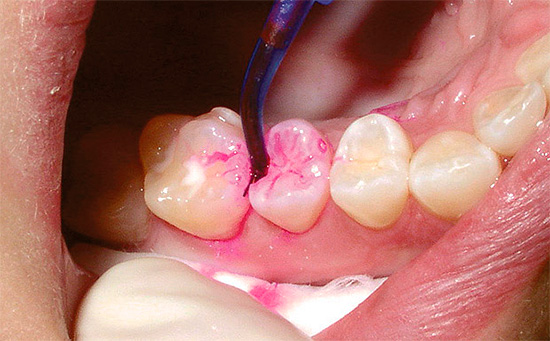 لا يُنصح عادةً بمعالجة الكثير من الأسنان بعلامة تسوس في وقت واحد ، لأن وقت تعرض المحلول منخفض جدًا ، لذلك قد لا يكون لديك الوقت لشطف المؤشر في الوقت المناسب.