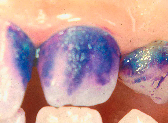 De foto toont een voorbeeld van het kleuren van een tand met methyleenblauw, dat in dit geval wordt gebruikt om eerste cariës te detecteren.