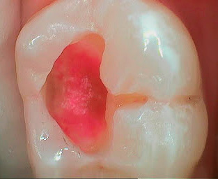 Când pregătiți un dinte, dentina afectată de carii este îndepărtată până când nu încetează să se coloreze cu un marker.