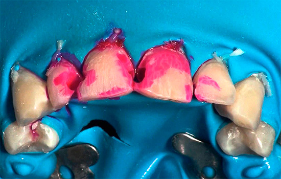 Syntetické barvivo fuchsin obarví tkáně postižené kazem v jasně červené barvě.
