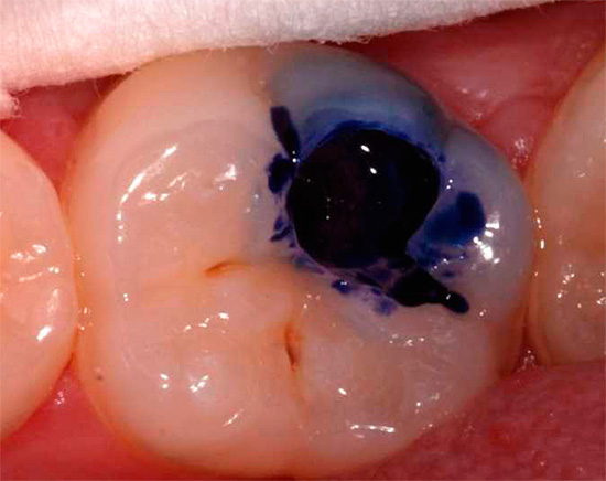 La photo montre un exemple d'une cavité carieuse nettoyée avec une perceuse, dans laquelle un marqueur de carie est ensuite versé