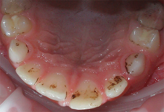 Уклањање зубног камена код трудница контраиндицирано је у првом тромесечју.