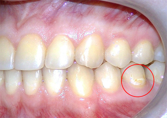 In some cases, only certain foci of initial caries appear during pregnancy, and women are in no hurry to treat them, trying to wait out this critical period.