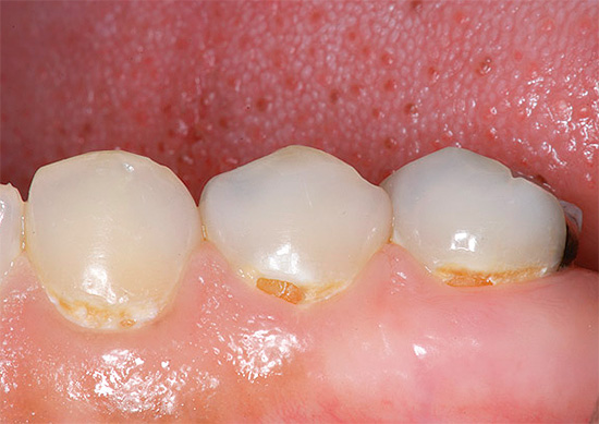 Zubní kaz během těhotenství může někdy dojít k akutní formě se silným a současným poškozením mnoha zubů najednou.