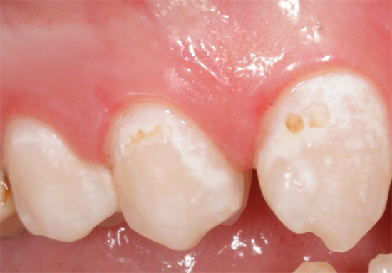 Der demineralisierte weiße Zahnschmelz ist auf dem Foto deutlich sichtbar, der anschließend allmählich zu pigmentieren beginnt, wenn die Behandlung nicht rechtzeitig begonnen wird.