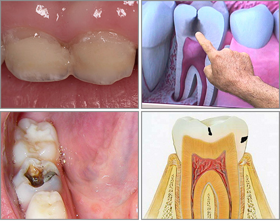 Despite the variety of different forms of caries, this pathological process always proceeds taking into account a number of patterns, which we will consider further ...