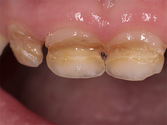 تسوس الأسنان اللبنية عند الأطفال أمر شائع بشكل خاص اليوم (يظهر مثال في الصورة)