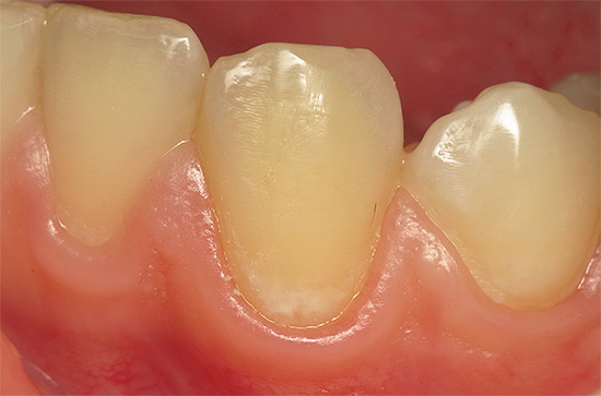 Caries in the spot stage
