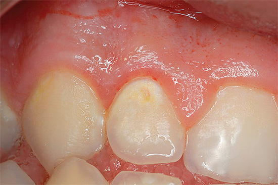Oberflächliche Karies (es ist offensichtlich, dass der Zahnschmelz bereits lokal pigmentiert ist)