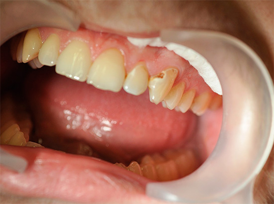 And this photo shows an example of average caries, at this stage of the development of the pathological process very pronounced painful sensations are already possible.