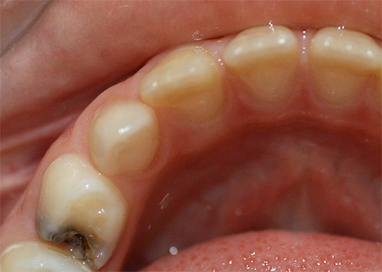 Derin çürüklerle (fotoğrafta) patolojik süreç dentin'i etkiler ve dişin pulpa odasına yaklaşabilir.