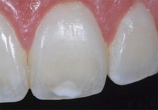 จุดสีขาวบนเคลือบฟันในกรณีที่ฟันผุเรื้อรังไม่สามารถรบกวนคุณได้เป็นเวลานาน ...