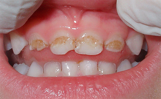 Mais avec des caries aiguës, les tissus dentaires durs peuvent être détruits littéralement en quelques semaines ou mois.