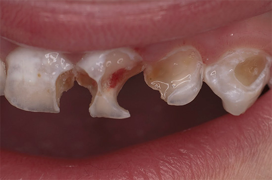 Zdjęcie pokazuje przykład wielu zmian zębów mlecznych z próchnicą butelkową