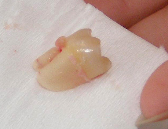 Pri neprítomnosti včasnej liečby môže byť nevyhnutné odstrániť mliečny zub, čo má niekedy závažný vplyv na tvorbu oklúzie u dieťaťa.