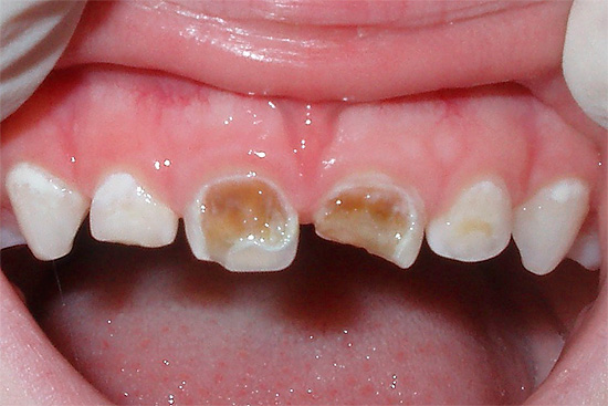แม้จะมีความจริงที่ว่าฟันน้ำนมจะตกลงมาในไม่ช้าก็เป็นสิ่งจำเป็นที่จะรักษาฟันผุกับพวกเขา