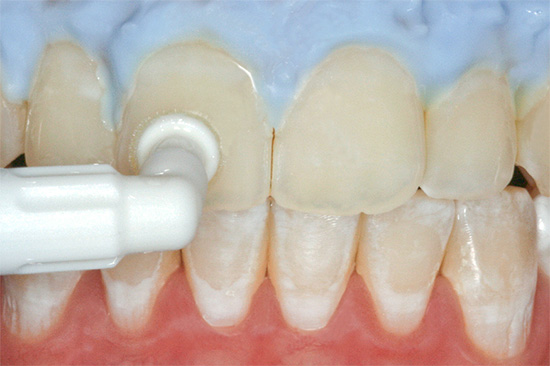يمكن علاج التسوس في مرحلة بقعة بيضاء بالطرق المحافظة - عن طريق استعادة مينا الأسنان باستخدام مستحضرات معدنية خاصة.