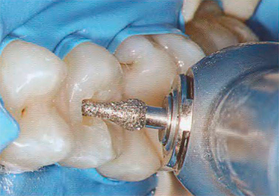 Ak je proteínová matrica skloviny kazená zubným kazom, vo väčšine prípadov bude potrebné použiť vŕtačku s následnou inštaláciou tesnenia, ktorá nahradí stratené tkanivo.