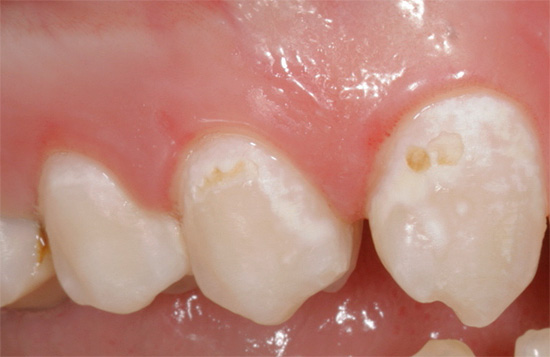 Das Foto zeigt ein Beispiel eines weißlichen und leuchtenden demineralisierten Zahnschmelzes (anfängliche Karies)
