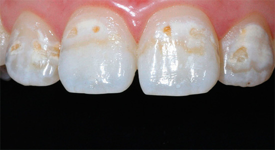 Ako se daljnji gubitak mineralnih sastojaka caklom zuba ne spriječi, nastavit će se urušavati produbljivanjem karioznih šupljina ...