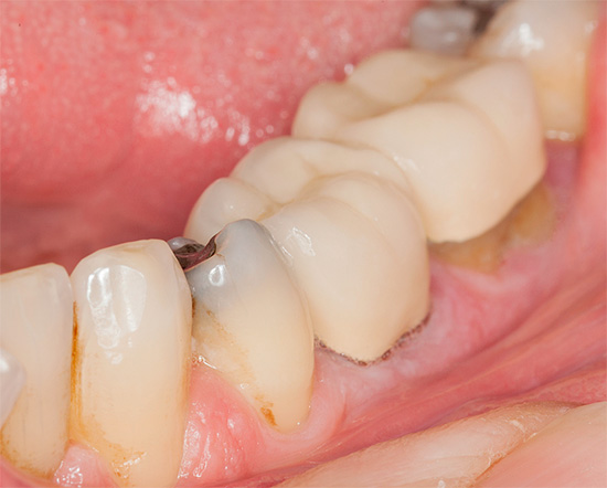 Även om det är allmänt trott att tandröta kan gå från en tand till en annan, men detta är en missuppfattning