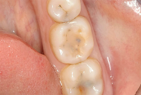 Днес в много страни почти всеки възрастен има признаци на кариозно увреждане на зъбите.