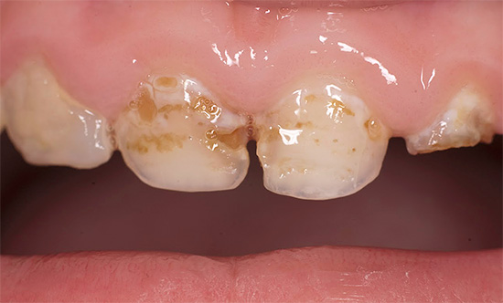 Often, the treatment of caries on milk teeth in a child is significantly more complicated than a similar procedure in adults ...