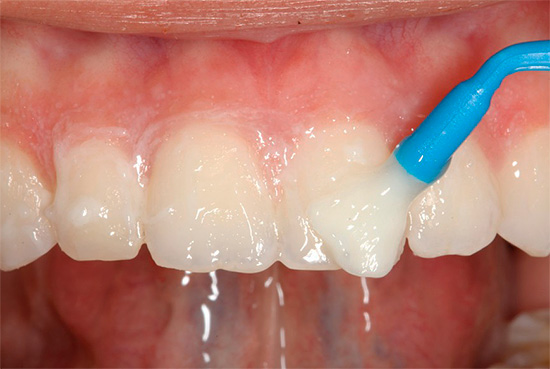 Si la carie n'affecte que l'émail d'une dent de lait, un traitement sans l'utilisation d'une perceuse est souvent possible (en reminéralisant la thérapie)