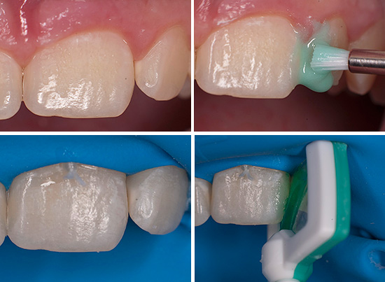 На снимката е показано стоматологичното лечение с помощта на технологията Icon.