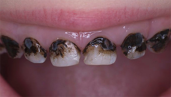 Süt dişlerinin gümüşleşmeden sonra böyle görünmesi - açıkçası, çok güzel değil.