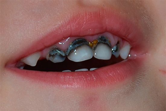 A més del desavantatge estètic, l’argentació de les dents també té una efectivitat generalment baixa contra la càries.