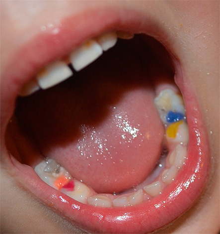 Voilà à quoi ressemblent les plombages colorés sur les dents de lait, parfois les enfants aiment se montrer à leurs amis.