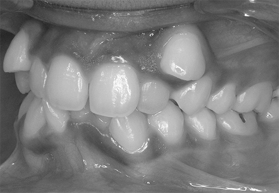 Süt dişlerinin çok hızlı kaybı (veya çıkarılması), sonraki maloklüzyona kolayca yol açabilir.