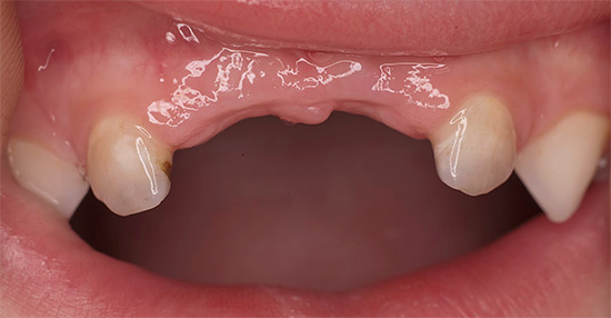 Innym problemem związanym ze zbyt wczesnym i ciężkim próchnicą zębów mlecznych z próchnicą jest niezdolność dziecka do normalnego żucia pokarmu.
