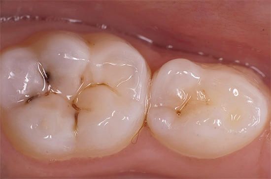 La photo montre un exemple de carie de fissure sur une dent de lait à mâcher.